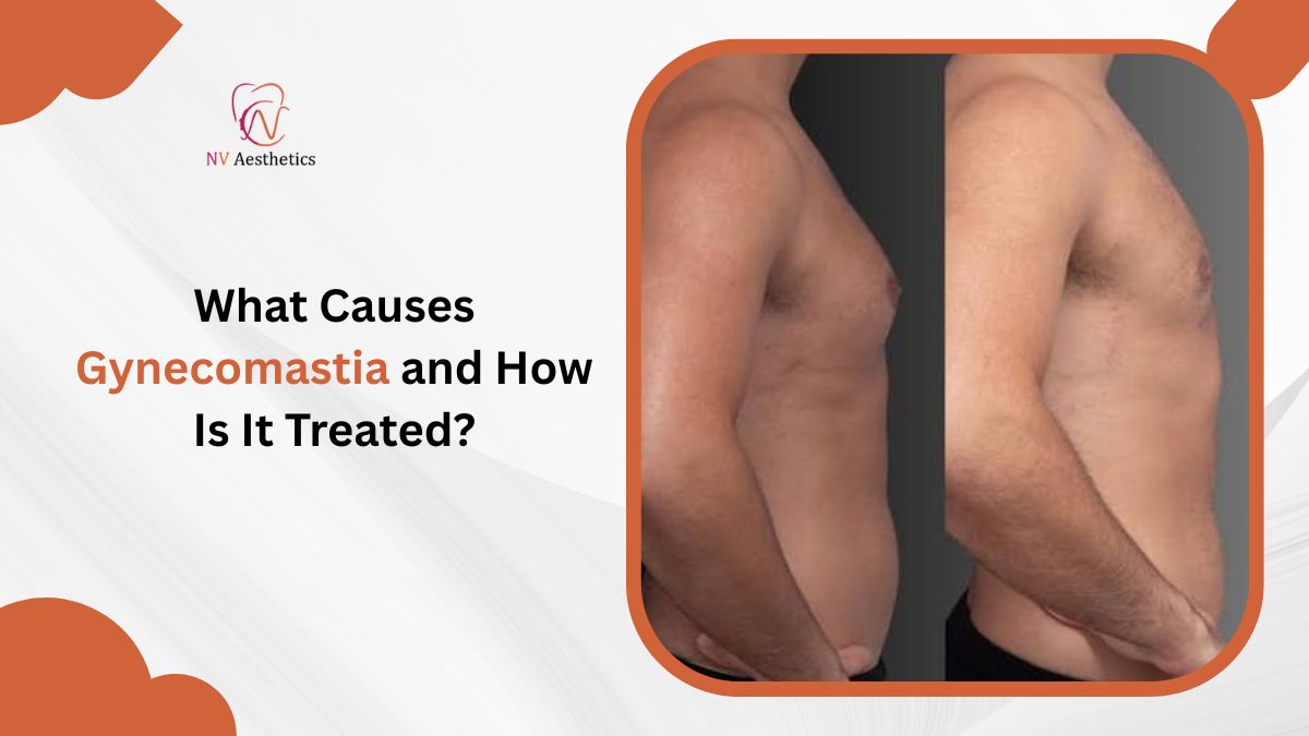 What Causes Gynecomastia and How Is It Treated?